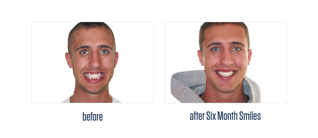 6 month smiles, Fast and Short Term Braces - Calgary Dentist
